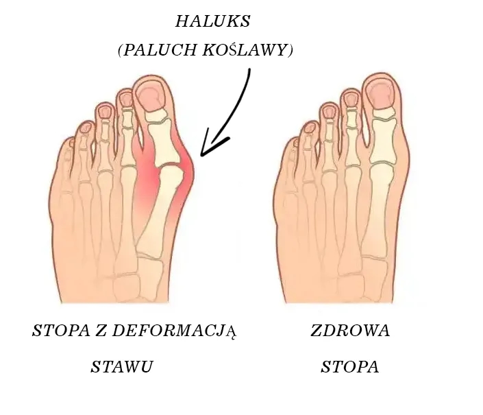 Jak wygląda haluks? Objawy, zdjęcia i metody leczenia deformacji stopy