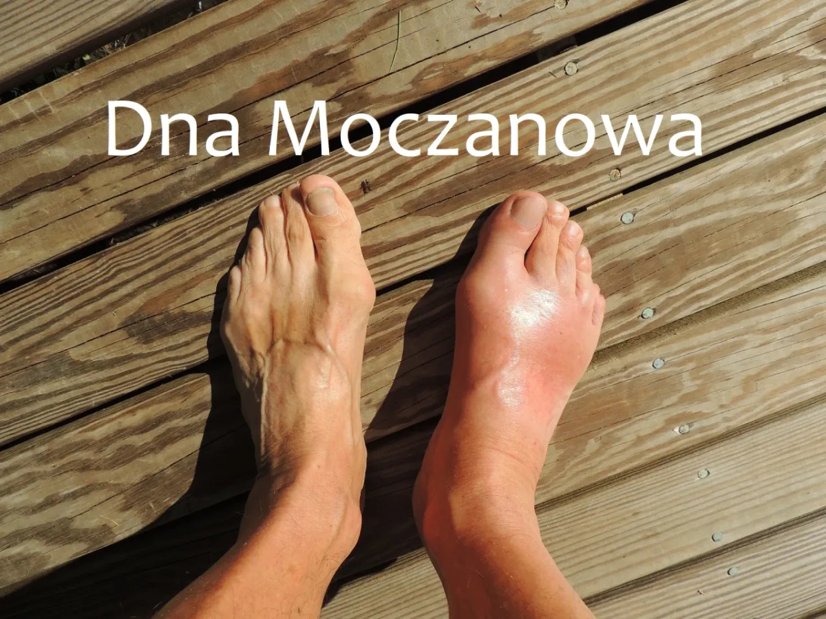 Dna moczanowa czy haluksy: różnice, objawy i skuteczne metody leczenia