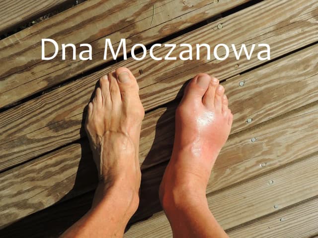 Dna moczanowa czy haluksy: różnice, objawy i skuteczne metody leczenia Dna moczanowa czy haluksy: różnice, objawy i skuteczne metody leczenia